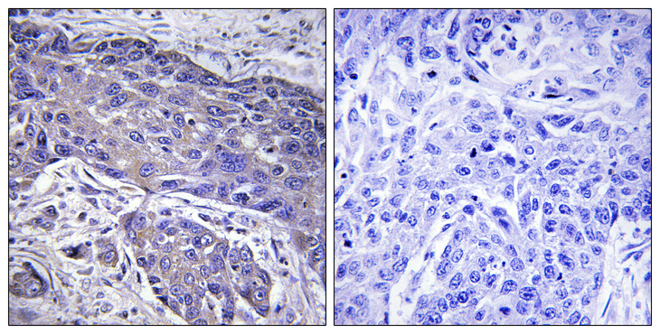 POFUT1 Antibody - Immunohistochemistry analysis of paraffin-embedded human lung carcinoma tissue, using POFUT1 Antibody. The picture on the right is blocked with the synthesized peptide.