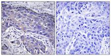 POFUT1 Antibody - Immunohistochemistry analysis of paraffin-embedded human lung carcinoma tissue, using POFUT1 Antibody. The picture on the right is blocked with the synthesized peptide.