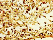 POFUT2 Antibody - Immunohistochemistry image at a dilution of 1:300 and staining in paraffin-embedded human melanoma cancer performed on a Leica BondTM system. After dewaxing and hydration, antigen retrieval was mediated by high pressure in a citrate buffer (pH 6.0) . Section was blocked with 10% normal goat serum 30min at RT. Then primary antibody (1% BSA) was incubated at 4 °C overnight. The primary is detected by a biotinylated secondary antibody and visualized using an HRP conjugated SP system.