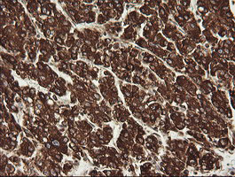 POGK Antibody - IHC of paraffin-embedded Carcinoma of Human liver tissue using anti-POGK mouse monoclonal antibody.