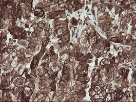 POGK Antibody - IHC of paraffin-embedded Adenocarcinoma of Human ovary tissue using anti-POGK mouse monoclonal antibody.