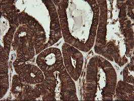 POGK Antibody - IHC of paraffin-embedded Adenocarcinoma of Human endometrium tissue using anti-POGK mouse monoclonal antibody.