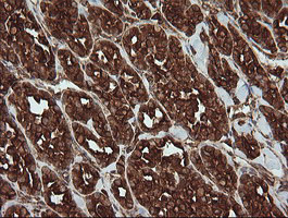 POGK Antibody - IHC of paraffin-embedded Carcinoma of Human thyroid tissue using anti-POGK mouse monoclonal antibody.