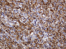 POGK Antibody - IHC of paraffin-embedded Human lymphoma tissue using anti-POGK mouse monoclonal antibody.