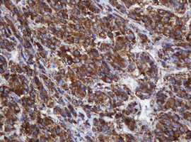 POGK Antibody - IHC of paraffin-embedded Carcinoma of Human liver tissue using anti-POGK mouse monoclonal antibody.