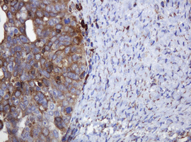 POGK Antibody - IHC of paraffin-embedded Adenocarcinoma of Human ovary tissue using anti-POGK mouse monoclonal antibody.