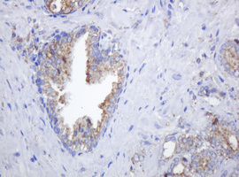 POGK Antibody - IHC of paraffin-embedded Carcinoma of Human prostate tissue using anti-POGK mouse monoclonal antibody.