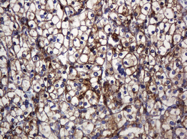 POGK Antibody - IHC of paraffin-embedded Carcinoma of Human kidney tissue using anti-POGK mouse monoclonal antibody.