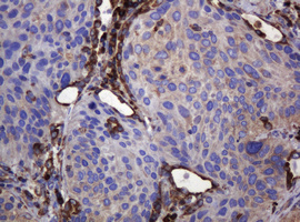 POGK Antibody - IHC of paraffin-embedded Carcinoma of Human lung tissue using anti-POGK mouse monoclonal antibody.
