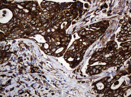 POGK Antibody - IHC of paraffin-embedded Adenocarcinoma of Human breast tissue using anti-POGK mouse monoclonal antibody.