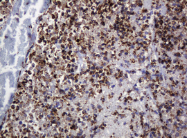 POGK Antibody - IHC of paraffin-embedded Adenocarcinoma of Human colon tissue using anti-POGK mouse monoclonal antibody.