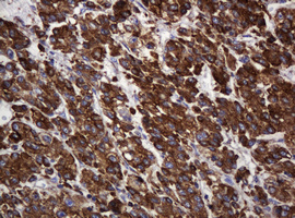 POGK Antibody - IHC of paraffin-embedded Carcinoma of Human liver tissue using anti-POGK mouse monoclonal antibody.