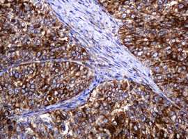 POGK Antibody - IHC of paraffin-embedded Adenocarcinoma of Human endometrium tissue using anti-POGK mouse monoclonal antibody.