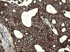 POGK Antibody - IHC of paraffin-embedded Adenocarcinoma of Human breast tissue using anti-POGK mouse monoclonal antibody.