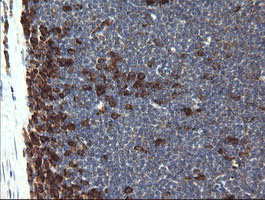 POGK Antibody - IHC of paraffin-embedded Human lymphoma tissue using anti-POGK mouse monoclonal antibody.
