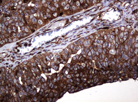 POGK Antibody - IHC of paraffin-embedded Adenocarcinoma of Human ovary tissue using anti-POGK mouse monoclonal antibody.