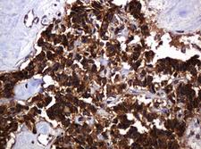 POGK Antibody - IHC of paraffin-embedded Carcinoma of Human pancreas tissue using anti-POGK mouse monoclonal antibody.