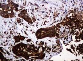 POGK Antibody - IHC of paraffin-embedded Carcinoma of Human bladder tissue using anti-POGK mouse monoclonal antibody.