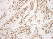 POGZ Antibody - Detection of Human POGZ by Immunohistochemistry. Sample: FFPE section of human breast carcinoma. Antibody: Affinity purified rabbit anti-POGZ used at a dilution of 1:250.