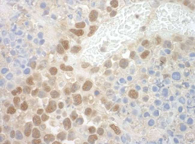 POGZ Antibody - Detection of Mouse POGZ by Immunohistochemistry. Sample: FFPE section of mouse hybridoma tumor. Antibody: Affinity purified rabbit anti-POGZ used at a dilution of 1:250.