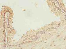 POGZ Antibody - Immunohistochemistry of paraffin-embedded human prostate cancer using antibody at dilution of 1:100.