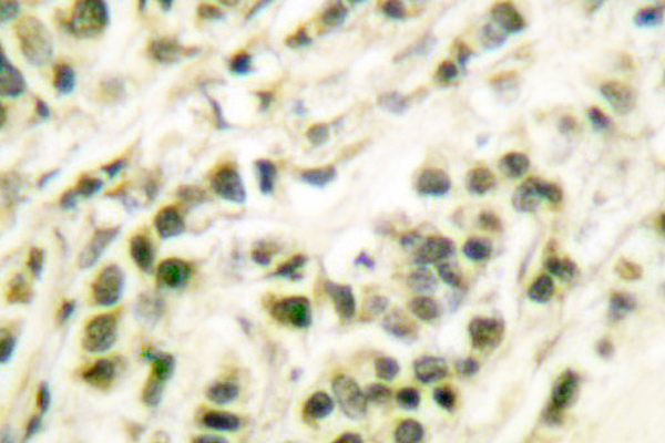 POLB / DNA Polymerase Beta Antibody - IHC of DNA Polymerase /DPOLB (Q324) pAb in paraffin-embedded human breast carcinoma tissue.