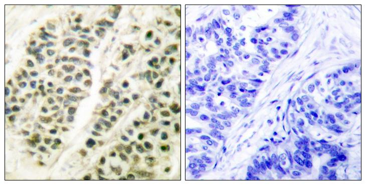 POLB / DNA Polymerase Beta Antibody - Peptide - + Immunohistochemical analysis of paraffin-embedded human breast carcinoma tissue using DNA Polymerase ß antibody.