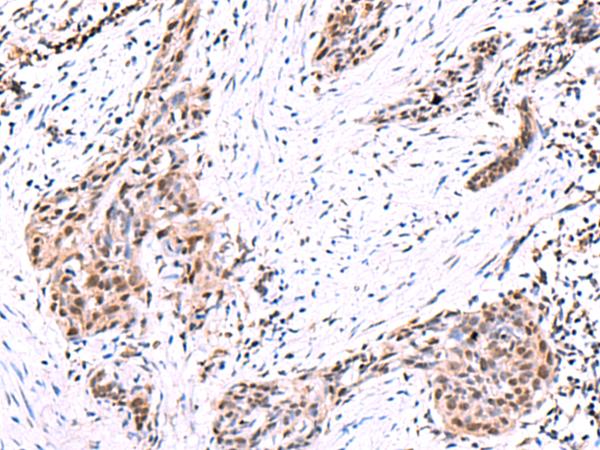 POLD2 Antibody - Immunohistochemistry of paraffin-embedded Human esophagus cancer tissue  using POLD2 Polyclonal Antibody at dilution of 1:95(×200)