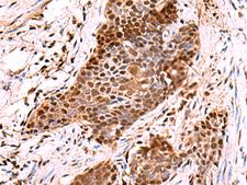 POLD2 Antibody - Immunohistochemistry of paraffin-embedded Human esophagus cancer tissue  using POLD2 Polyclonal Antibody at dilution of 1:60(×200)