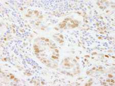 POLD3 Antibody - Detection of Human PolD3/p66 by Immunohistochemistry. Sample: FFPE section of human breast carcinoma. Antibody: Affinity purified rabbit anti-PolD3/p66 used at a dilution of 1:250.