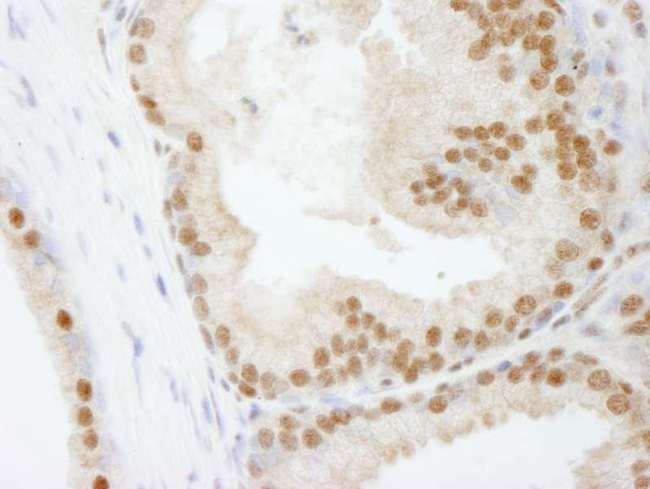 POLD3 Antibody - Detection of Human PolD3/p66 by Immunohistochemistry. Sample: FFPE section of human prostate carcinoma. Antibody: Affinity purified rabbit anti-PolD3/p66 used at a dilution of 1:250.
