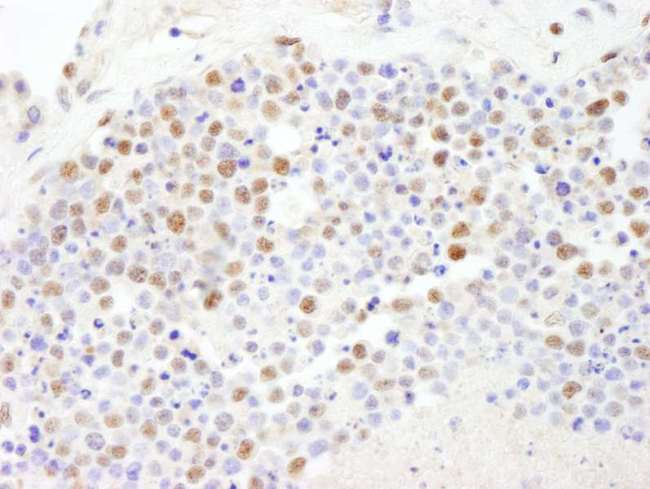 POLD3 Antibody - Detection of Human PolD3/p66 by Immunohistochemistry. Sample: FFPE section of human small cell lung cancer. Antibody: Affinity purified rabbit anti-PolD3/p66 used at a dilution of 1:1000 (1 ug/ml). Detection: DAB.
