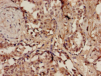 POLE / POLE1 Antibody - Immunohistochemistry analysis of human breast cancer at a dilution of 1:100