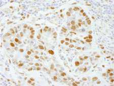 POLE3 / DNA Polymerase Epsilon Antibody - Detection of Human PolD3/p66 by Immunohistochemistry. Sample: FFPE section of human breast carcinoma. Antibody: Affinity purified rabbit anti-PolE3/p17 used at a dilution of 1:100.