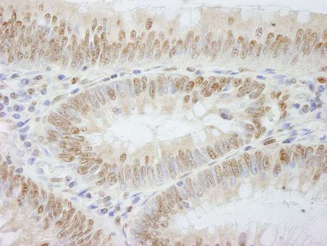 POLE3 / DNA Polymerase Epsilon Antibody - Detection of Human PolE3/p17 by Immunohistochemistry. Sample: FFPE section of human colon carcinoma. Antibody: Affinity purified rabbit anti-PolE3/p17 used at a dilution of 1:500.