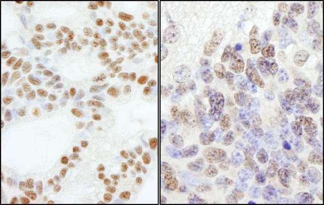 POLE3 / DNA Polymerase Epsilon Antibody - Detection of Human and Mouse PolE3/p17 by Immunohistochemistry. Sample: FFPE section of human ovarian carcinoma (left) and mouse teratoma (right). Antibody: Affinity purified rabbit anti-PolE3/p17 used at a dilution of 1:5000 (0.2 ug/ml). Detection: DAB.