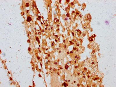 POLE4 / p12 Antibody - Immunohistochemistry Dilution at 1:400 and staining in paraffin-embedded human melanoma cancer performed on a Leica BondTM system. After dewaxing and hydration, antigen retrieval was mediated by high pressure in a citrate buffer (pH 6.0). Section was blocked with 10% normal Goat serum 30min at RT. Then primary antibody (1% BSA) was incubated at 4°C overnight. The primary is detected by a biotinylated Secondary antibody and visualized using an HRP conjugated SP system.