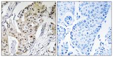 POLE4 / p12 Antibody - Peptide - + Immunohistochemistry analysis of paraffin-embedded human breast carcinoma tissue using POLE4 antibody.