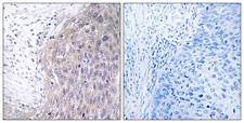 POLG2 Antibody - Peptide - + Immunohistochemistry analysis of paraffin-embedded human cervix carcinoma tissue using POLG2 antibody.