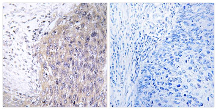 POLG2 Antibody - Peptide - + Immunohistochemistry analysis of paraffin-embedded human cervix carcinoma tissue using POLG2 antibody.