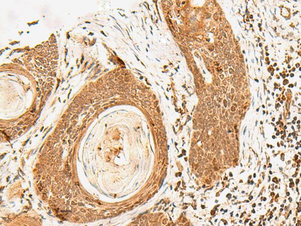 POLH / DNA Polymerase Eta Antibody - Immunohistochemistry of paraffin-embedded Human esophagus cancer tissue  using POLH Polyclonal Antibody at dilution of 1:60(×200)