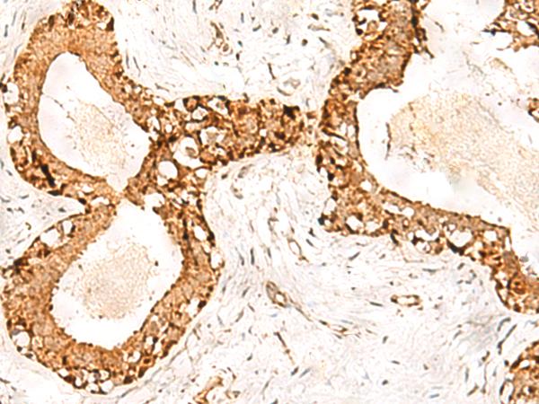 POLH / DNA Polymerase Eta Antibody - Immunohistochemistry of paraffin-embedded Human breast cancer tissue  using POLH Polyclonal Antibody at dilution of 1:60(×200)