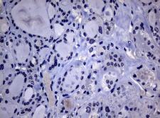 POLI Antibody - IHC of paraffin-embedded Carcinoma of Human thyroid tissue using anti-POLI mouse monoclonal antibody. (Heat-induced epitope retrieval by 10mM citric buffer, pH6.0, 120°C for 3min).