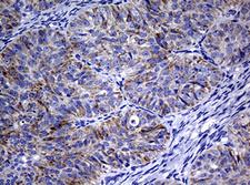 POLI Antibody - IHC of paraffin-embedded Adenocarcinoma of Human ovary tissue using anti-POLI mouse monoclonal antibody. (Heat-induced epitope retrieval by 10mM citric buffer, pH6.0, 120°C for 3min).