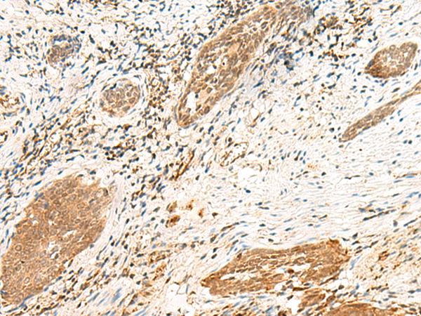 POLR1D Antibody - Immunohistochemistry of paraffin-embedded Human esophagus cancer tissue  using POLR1D Polyclonal Antibody at dilution of 1:50(×200)