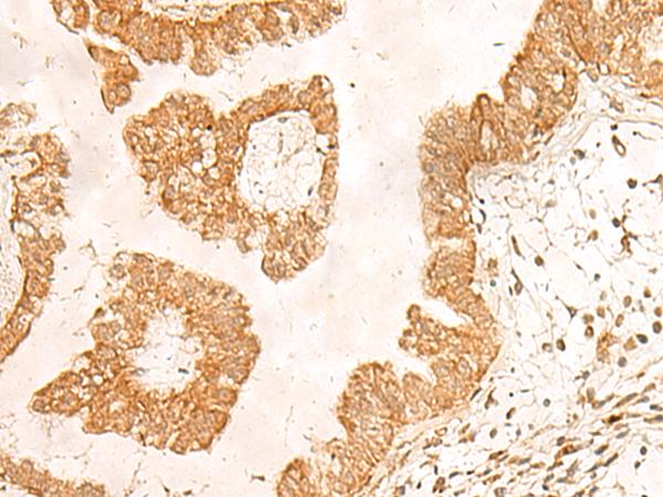 POLR1D Antibody - Immunohistochemistry of paraffin-embedded Human liver cancer tissue  using POLR1D Polyclonal Antibody at dilution of 1:50(×200)