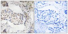 POLR1E Antibody - Immunohistochemistry of paraffin-embedded human breast carcinoma tissue using POLR1E antibody.
