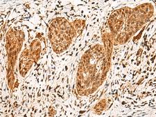 POLR1E Antibody - Immunohistochemistry of paraffin-embedded Human esophagus cancer tissue  using POLR1E Polyclonal Antibody at dilution of 1:40(×200)