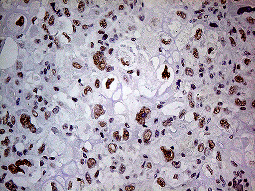 POLR2A / RNA polymerase II Antibody - Immunohistochemical staining of paraffin-embedded Adenocarcinoma of Human breast tissue tissue using anti-POLR2A mouse monoclonal antibody. (Heat-induced epitope retrieval by 1mM EDTA in 10mM Tris buffer. (pH8.5) at 120°C for 3 min. (1:500)
