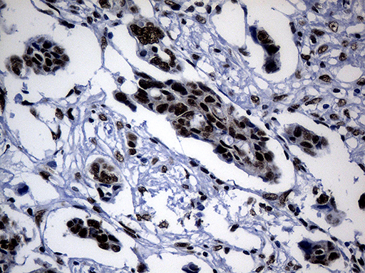 POLR2A / RNA polymerase II Antibody - Immunohistochemical staining of paraffin-embedded Adenocarcinoma of Human ovary tissue using anti-POLR2A mouse monoclonal antibody. (Heat-induced epitope retrieval by 1mM EDTA in 10mM Tris buffer. (pH8.5) at 120°C for 3 min. (1:500)
